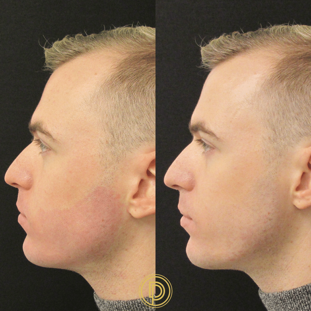 Jaw Contouring Filler Dallas Jaw Filler Dallas Dallas Dermatology