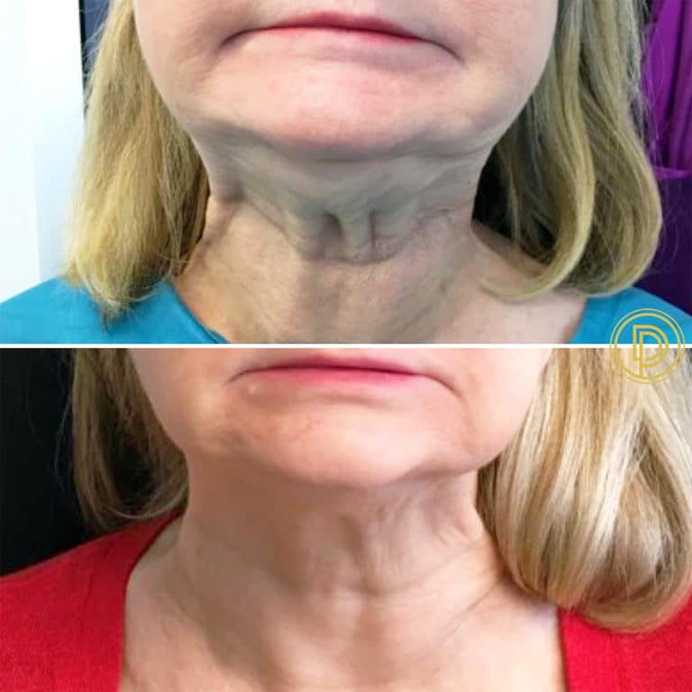 Neck Botox Dallas | Botox Neck Injections Dallas | Botox for Neck Bands ...