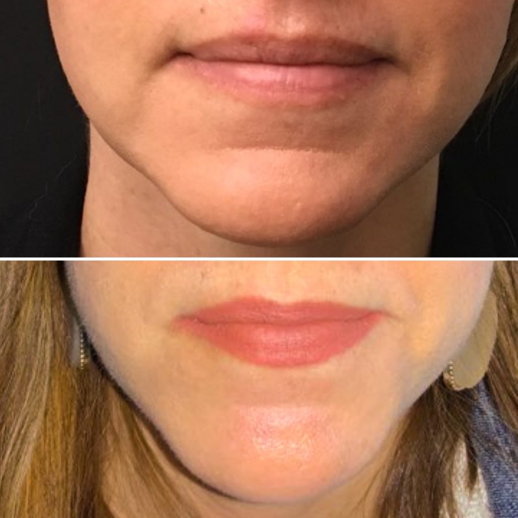 lip filler before and after