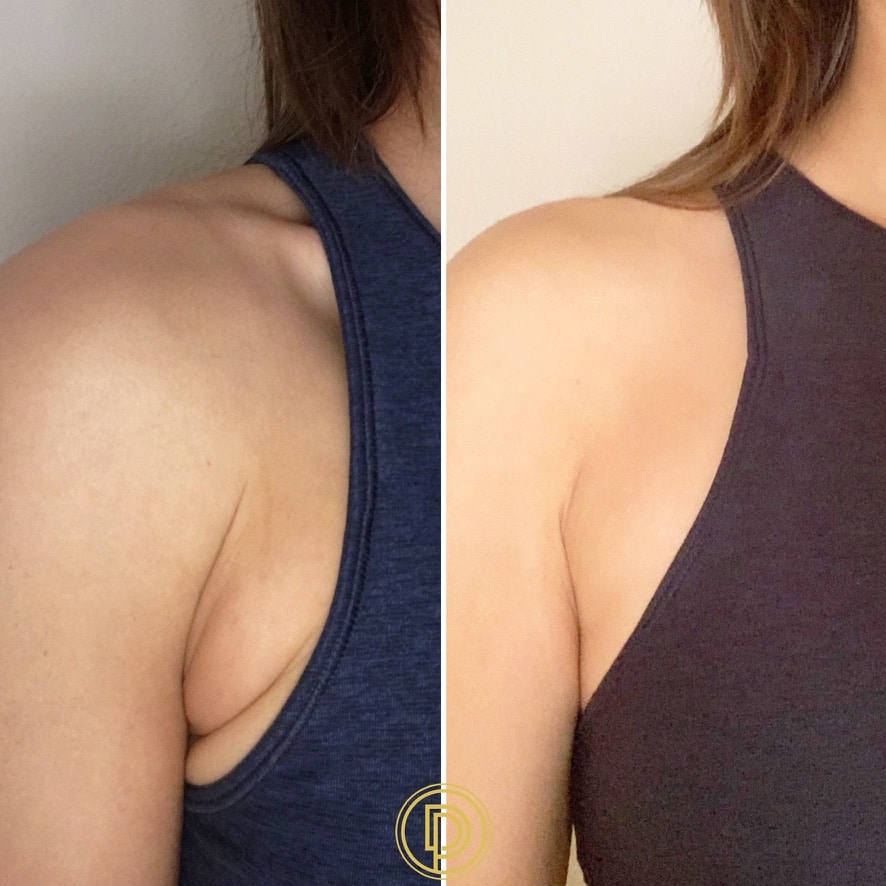 Armpit Fat Removal (Bra Bulge): Lipo, Arm Lift, Coolsculpting, and Kybella