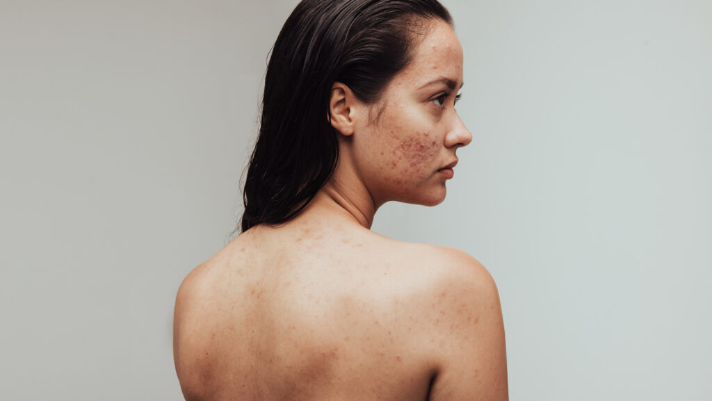 severe adult acne