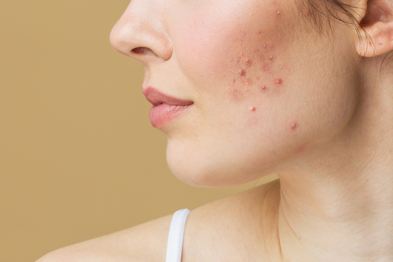 How To Treat Hormonal Acne Dallas Dermatology Partners