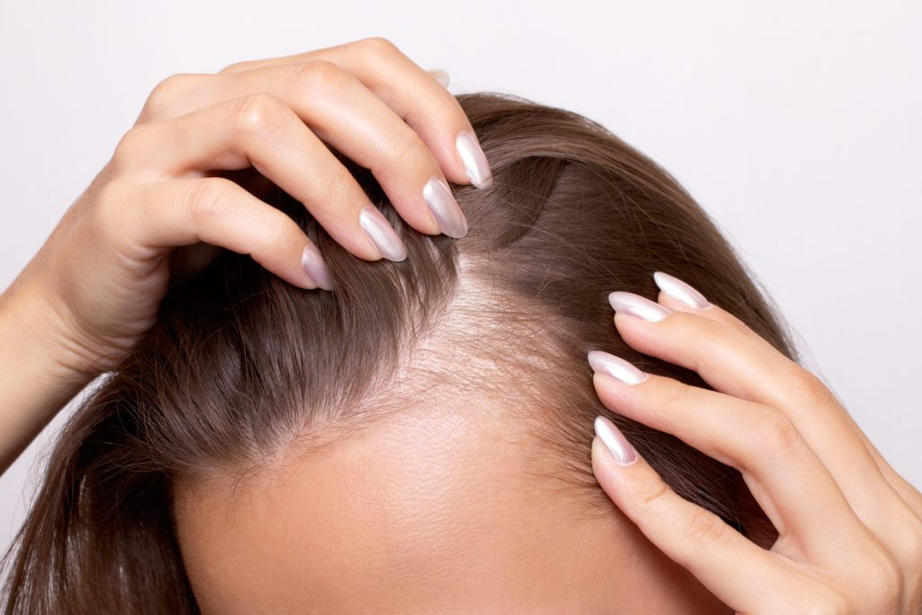 Young woman with hair loss showing bald spots on forehead and temples