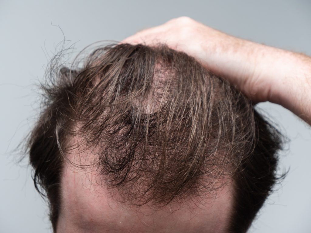 Balding Man showing hair loss at the front of his head